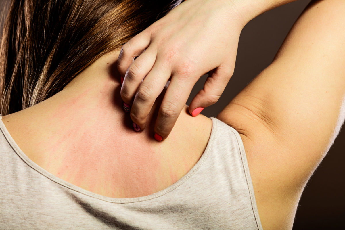 Health problem. Closeup young woman scratching her itchy back with allergy rash