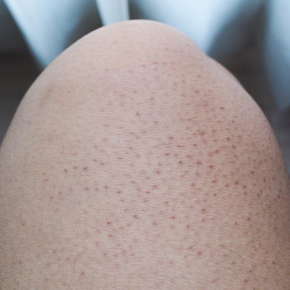 KERATOSIS PILARIS - Dermatology Associates