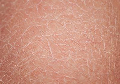 dry skin close up