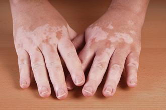 2 hands discoloring