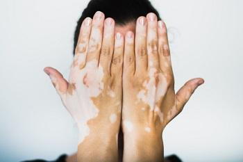 vitiligo hands in front of face