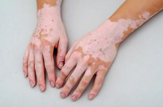 hands with vitiligo