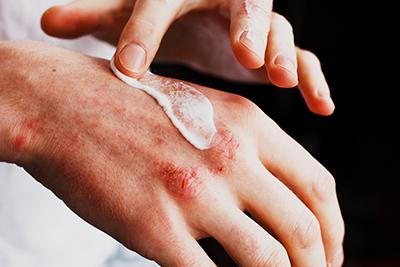 lotion on hands with skin condition