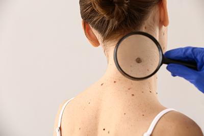 mole on woman being examined with magnifying glass