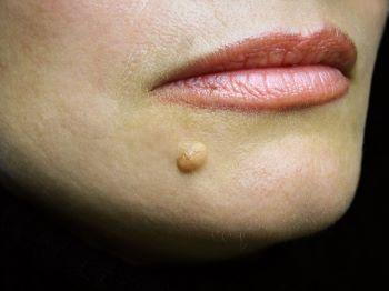 mole on woman's chin area