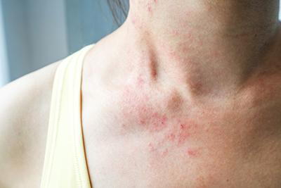 neck and chest with rash