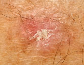 possible skin condition like actinic keratosis