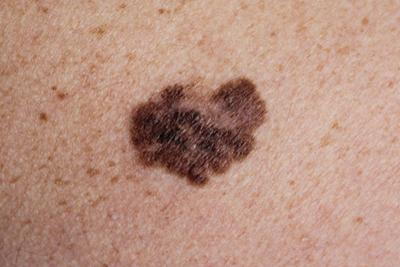 possible skin cancer spot