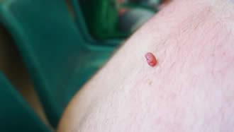 skin tag