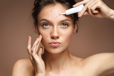 woman treating face acne